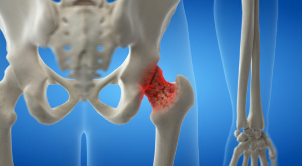 Knochen, Muskeln & Sturzrisiko