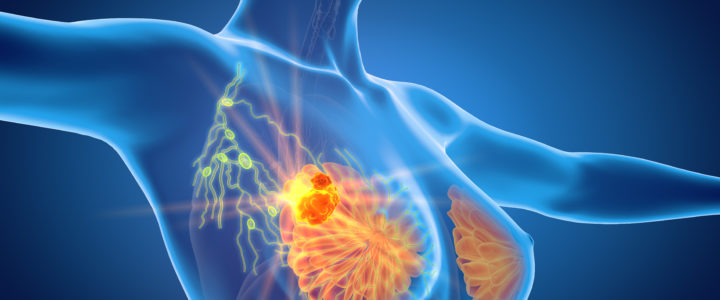 Brustkrebsdarstellung